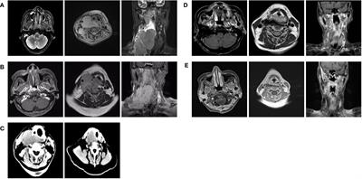 Toripalimab plus cetuximab combined with radiotherapy in a locally advanced platinum-based chemotherapy-insensitive nasopharyngeal carcinoma patient: a case report